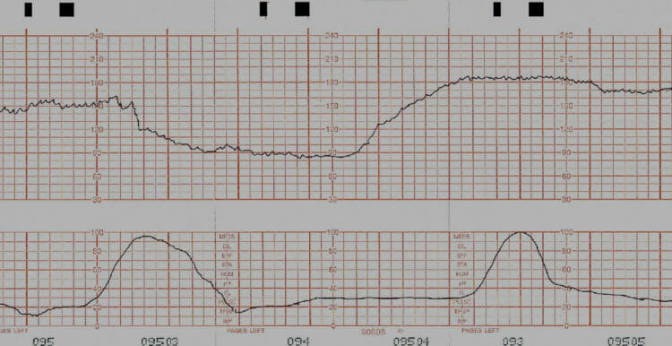 Pregnancy: Prolonged deceleration