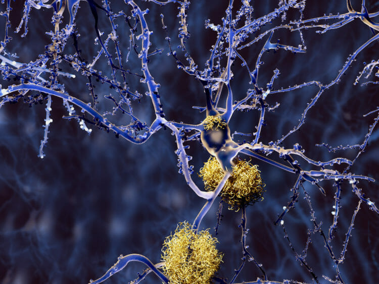 Keto can Prevent Alzheimer’s And Other Mental Diseases